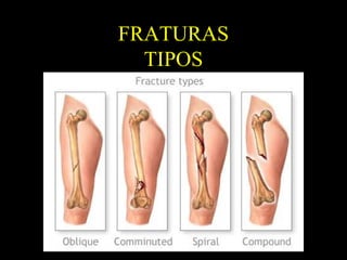 FRATURAS
TIPOS
 