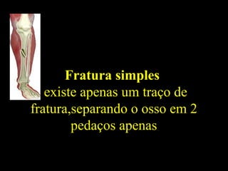 Fratura simples
existe apenas um traço de
fratura,separando o osso em 2
pedaços apenas
 