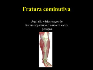 Fratura cominutiva
Aqui são vários traços de
fratura,separando o osso em vários
pedaços
 