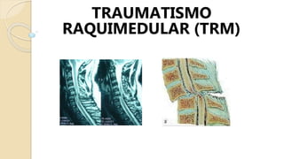 TRAUMATISMO
RAQUIMEDULAR (TRM)
 