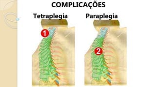 COMPLICAÇÕES
Tetraplegia Paraplegia
 
