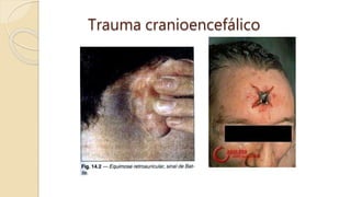 Trauma cranioencefálico
 
