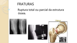 FRATURAS
Ruptura total ou parcial da estrutura
óssea.
 