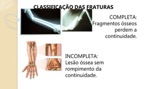 CLASSIFICAÇÃO DAS FRATURAS
COMPLETA:
Fragmentos ósseos
perdem a
continuidade.
INCOMPLETA:
Lesão óssea sem
rompimento da
continuidade.
 