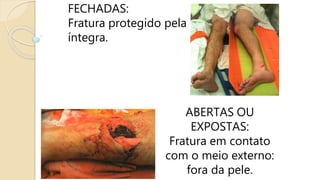 FECHADAS:
Fratura protegido pela pele
íntegra.
ABERTAS OU
EXPOSTAS:
Fratura em contato
com o meio externo:
fora da pele.
 