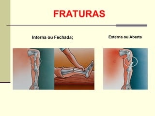 Interna ou Fechada; Externa ou Aberta
FRATURAS
 