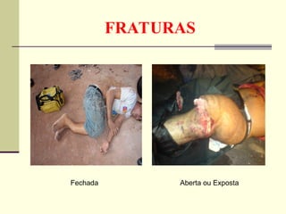 FRATURAS
Fechada Aberta ou Exposta
 