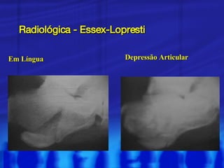 Radiológica - Essex-Lopresti Em Língua Depressão Articular 
