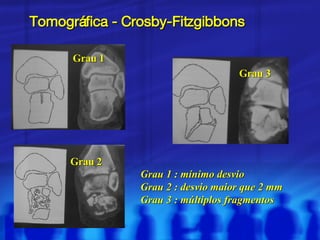 Tomográfica - Crosby-Fitzgibbons Grau 1 Grau 2 Grau 3 Grau 1 : mínimo desvio Grau 2 : desvio maior que 2 mm Grau 3 : múltiplos fragmentos 