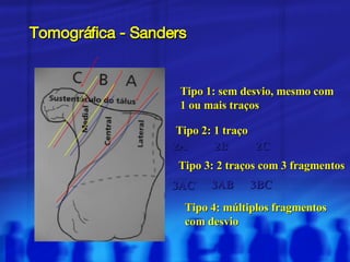 Tomográfica - Sanders Tipo 1: sem desvio, mesmo com 1 ou mais traços Tipo 2: 1 traço 2A 2B 2C Tipo 3: 2 traços com 3 fragmentos 3AC 3AB 3BC Tipo 4: múltiplos fragmentos com desvio 