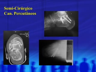 Semi-Cirúrgico Can. Percutâneos 