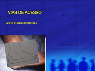 VIAS DE ACESSO Lateral Clássica Modificada Mediais Combinadas 