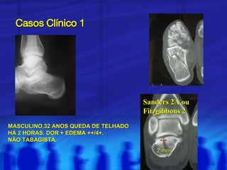 Casos Clínico 1 MASCULINO,32 ANOS QUEDA DE TELHADO HÁ 2 HORAS. DOR + EDEMA ++/4+. NÃO TABAGISTA. 2 mm Sanders 2A ou  Fitzgibbons 2 