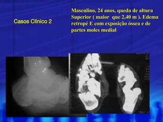 Casos Clínico 2 Masculino, 24 anos, queda de altura Superior ( maior  que 2,40 m ). Edema retropé E com exposição óssea e de partes moles medial 