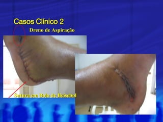 Casos Clínico 2 Sutura em Bola de Beisebol Dreno de Aspiração 
