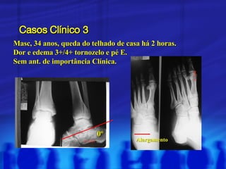 Casos Clínico 3 Masc, 34 anos, queda do telhado de casa há 2 horas. Dor e edema 3+/4+ tornozelo e pé E. Sem ant. de importância Clínica. 0º Alargamento 