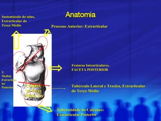 Anatomia Fraturas Intrarticulares,  FACETA POSTERIOR Processo Anterior: Extrarticular Tuberosidade do Calcaneo: Extrarticular Posterior Tubérculo Lateral e Troclea, Extrarticular  do Terço Médio T. Medial, Extrarticu-lar Posterior CORPO,  do Terço Médio, EA Sustentáculo do talus, Extrarticular do Terço Médio 