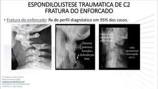 • Fratura do enforcado: Rx de perfil diagnóstico em 95% dos casos.
ESPONDILOLISTESE TRAUMATICA DE C2
FRATURA DO ENFORCADO
 