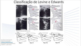 Classificação de Levine e Edwards
 