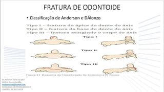 FRATURA DE ODONTOIDE
• Classificação de Anderson e DÁlonzo
 