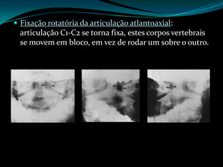  Fixação rotatória da articulação atlantoaxial:
  articulação C1-C2 se torna fixa, estes corpos vertebrais
  se movem em bloco, em vez de rodar um sobre o outro.
 