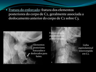  Fratura do enforcado: fratura dos elementos
 posteriores do corpo de C2, geralmente associada a
 deslocamento anterior do corpo de C2 sobre C3.



                                  Fratura através
                                  dos elementos
                                  posteriores de
                                        C2.
                   Elementos                            Linha
                   posteriores                      espinolaminal
                  fraturados e                      interrompida
                deslocados para                        em C2.
                     baixo.
 