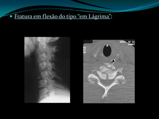  Fratura em flexão do tipo “em Lágrima”:
 