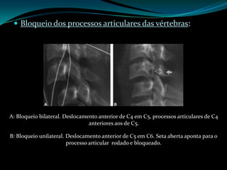  Bloqueio dos processos articulares das vértebras:




A: Bloqueio bilateral. Deslocamento anterior de C4 em C5, processos articulares de C4
                                anteriores aos de C5.

B: Bloqueio unilateral. Deslocamento anterior de C5 em C6. Seta aberta aponta para o
                        processo articular rodado e bloqueado.
 