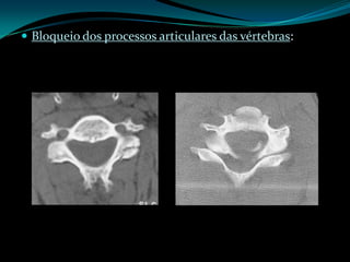  Bloqueio dos processos articulares das vértebras:
 