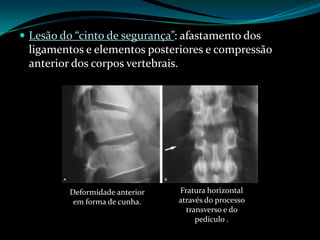  Lesão do “cinto de segurança”: afastamento dos
 ligamentos e elementos posteriores e compressão
 anterior dos corpos vertebrais.




          Deformidade anterior   Fratura horizontal
           em forma de cunha.    através do processo
                                   transverso e do
                                      pedículo .
 