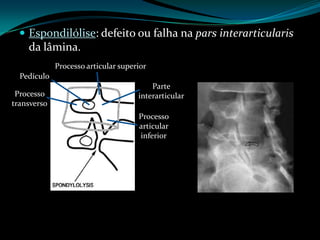  Espondilólise: defeito ou falha na pars interarticularis
    da lâmina.
             Processo articular superior
  Pedículo
                                         Parte
 Processo                            interarticular
transverso
                                     Processo
                                     articular
                                     inferior
 