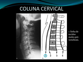 COLUNA CERVICAL


                  1: linha de
                  tecidos
                  moles pré-
                  vertebrais.
 