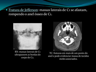  Fratura de Jefferson: massas laterais de C1 se afastam,
  rompendo o anel ósseo de C1.




      RX: massas laterais de C1
                                   TC: fraturas em mais de um ponto do
      ultrapassem as bordas do
                                  anel e pode evidenciar massa de tecidos
            corpo de C2.
                                             moles associados.
 