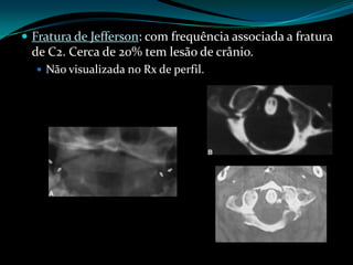  Fratura de Jefferson: com frequência associada a fratura
 de C2. Cerca de 20% tem lesão de crânio.
   Não visualizada no Rx de perfil.
 