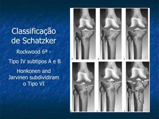 Classificação
de Schatzker
Rockwood 6ª -
Tipo IV subtipos A e B
Honkonen and
Jarvinen subdividiram
o Tipo VI
 