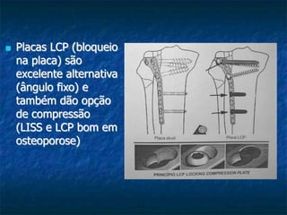  Placas LCP (bloqueio
na placa) são
excelente alternativa
(ângulo fixo) e
também dão opção
de compressão
(LISS e LCP bom em
osteoporose)
 