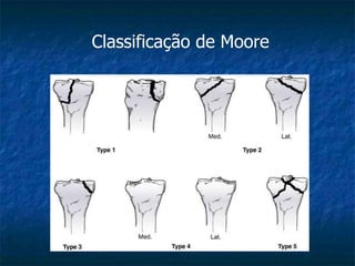 Classificação de Moore
 