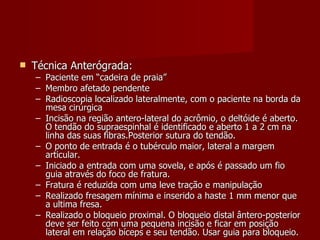 Técnica Anterógrada: Paciente em “cadeira de praia” Membro afetado pendente Radioscopia localizado lateralmente, com o paciente na borda da mesa cirúrgica Incisão na região antero-lateral do acrômio, o deltóide é aberto. O tendão do supraespinhal é identificado e aberto 1 a 2 cm na linha das suas fibras.Posterior sutura do tendão. O ponto de entrada é o tubérculo maior, lateral a margem articular. Iniciado a entrada com uma sovela, e após é passado um fio guia através do foco de fratura. Fratura é reduzida com uma leve tração e manipulação Realizado fresagem mínima e inserido a haste 1 mm menor que a ultima fresa. Realizado o bloqueio proximal. O bloqueio distal ântero-posterior deve ser feito com uma pequena incisão e ficar em posição lateral em relação bíceps e seu tendão. Usar guia para bloqueio. 