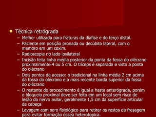 Técnica retrógrada Melhor utilizada para fraturas da diafise e do terço distal. Paciente em posição pronada ou decúbito lateral, com o membro em um coxim. Radioscopia no lado ipsilateral Incisão feita linha média posterior da ponta da fossa do olécrano proximalmente 4 ou 5 cm. O tríceps é separada e visto a ponta do olécrano Dois pontos de acesso: o tradicional na linha média 2 cm acima da fossa do olécrano e a mais recente borda superior da fossa do olécrano O restante do procedimento é igual a haste anterógrada, porém o bloqueio proximal deve ser feito em um local sem risco de lesão do nervo axilar, geralmente 1,5 cm da superfície articular da cabeça Lavagem com soro fisiológico para retirar os restos da fresagem para evitar formação óssea heterotopica. 