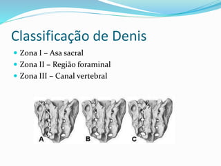 Classificação de Denis
 Zona I – Asa sacral
 Zona II – Região foraminal
 Zona III – Canal vertebral
 