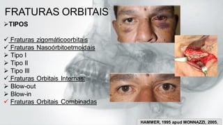 FRATURAS ORBITAIS
➢TIPOS
✓ Fraturas zigomáticoorbitais
✓ Fraturas Nasoórbitoetmoidais
➢ Tipo I
➢ Tipo II
➢ Tipo III
✓ Fraturas Orbitais Internas:
➢ Blow-out
➢ Blow-in
✓ Fraturas Orbitais Combinadas
HAMMER, 1995 apud MONNAZZI, 2005.
 