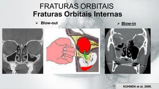 FRATURAS ORBITAIS
Fraturas Orbitais Internas
➢ Blow-out ➢ Blow-in
KUHNEN et al, 2006.
 