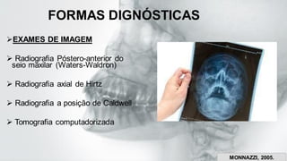 FORMAS DIGNÓSTICAS
➢EXAMES DE IMAGEM
➢ Radiografia Póstero-anterior do
seio maxilar (Waters-Waldron)
➢ Radiografia axial de Hirtz
➢ Radiografia a posição de Caldwell
➢ Tomografia computadorizada
MONNAZZI, 2005.
 