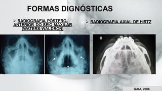 FORMAS DIGNÓSTICAS
➢ RADIOGRAFIA PÓSTERO-
ANTERIOR DO SEIO MAXILAR
(WATERS-WALDRON)
➢ RADIOGRAFIA AXIAL DE HIRTZ
encurtador.com.br/ilxzk
GAIA, 2008.
 