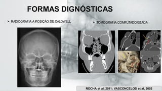 FORMAS DIGNÓSTICAS
➢ TOMOGRAFIA COMPUTADORIZADA
➢ RADIOGRAFIA A POSIÇÃO DE CALDWELL
ROCHA et al, 2011; VASCONCELOS et al, 2003
 