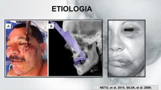 ETIOLOGIA
NETO, et al. 2015; SILVA, et al. 2009;
 
