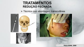 TRATAMENTOS
REDUÇÃO FECHADA
➢ Técnica com abordagem transcutânea
Fonseca, 2015.
PAULESINI, 2008
 