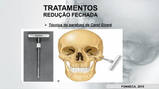 TRATAMENTOS
REDUÇÃO FECHADA
➢ Técnica do parafuso de Carol Girard
FONSECA, 2015
 