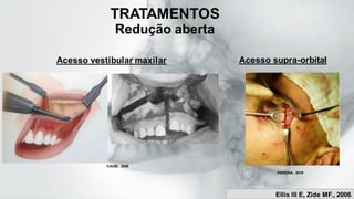 TRATAMENTOS
Redução aberta
Acesso vestibular maxilar Acesso supra-orbital
PEREIRA, 2019.
CAUBI, 2008
Ellis lll E, Zide MF., 2006
 
