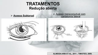 TRATAMENTOS
Redução aberta
➢ Acesso Subtarsal
➢ Acesso transconjutival com
cantatomia lateral
TIMOTÉO, 2009
IM
ALMEIDA ARB ET AL, 2011 ; TIMOTEO, 2009.
 
